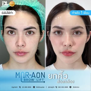 รีวิวลูกค้าที่ทำศัลยกรรมยกคิ้ว