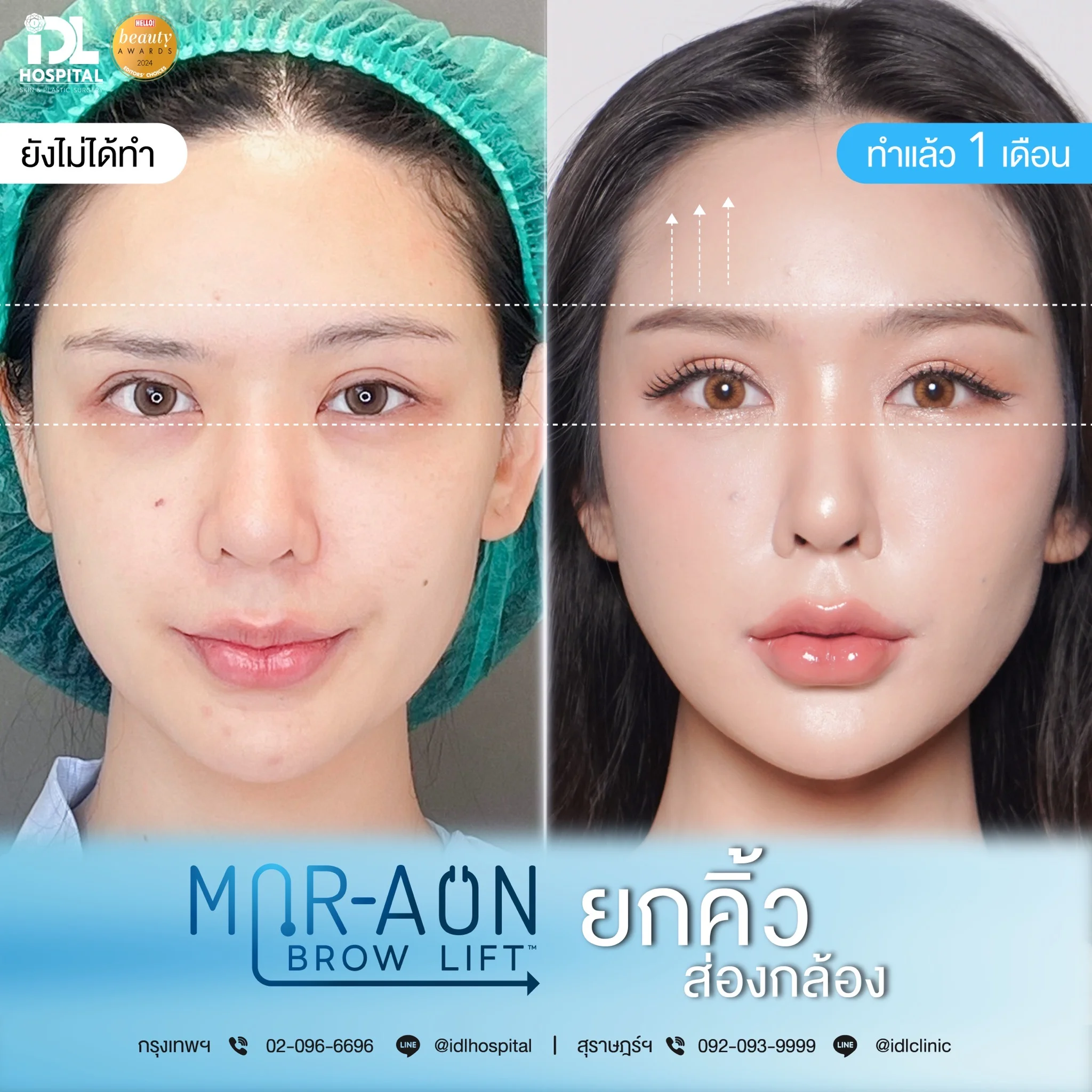 รีวิวลูกค้าที่ทำศัลยกรรมยกคิ้ว