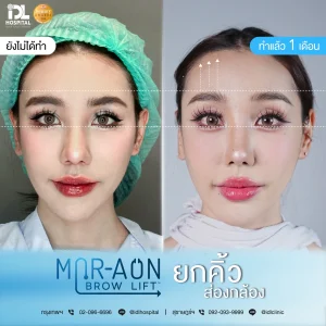 รีวิวลูกค้าที่ทำศัลยกรรมยกคิ้ว