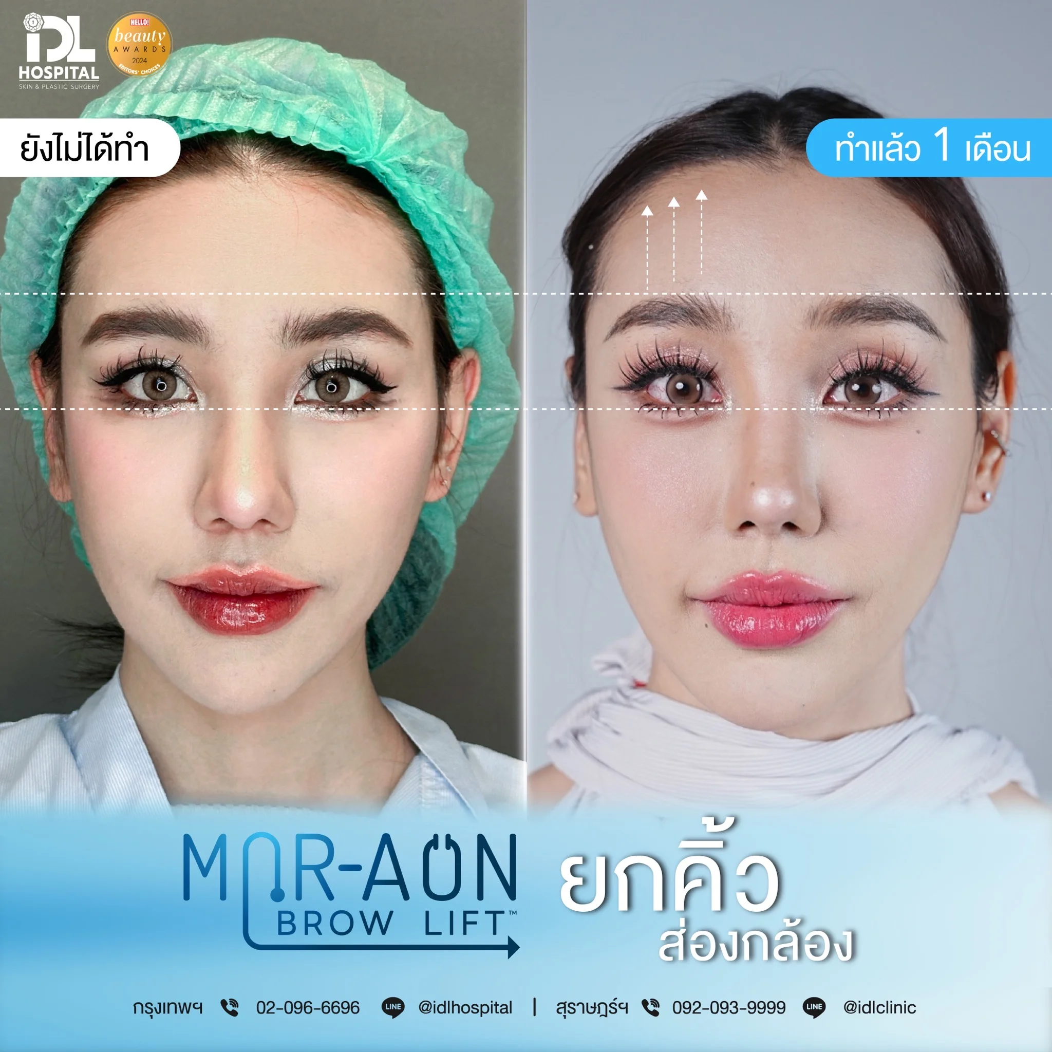 รีวิวลูกค้าที่ทำศัลยกรรมยกคิ้ว
