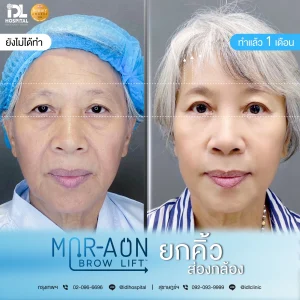 รีวิวลูกค้าที่ทำศัลยกรรมยกคิ้ว