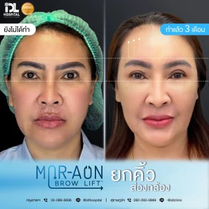 รีวิวลูกค้าที่ทำศัลยกรรมยกคิ้ว