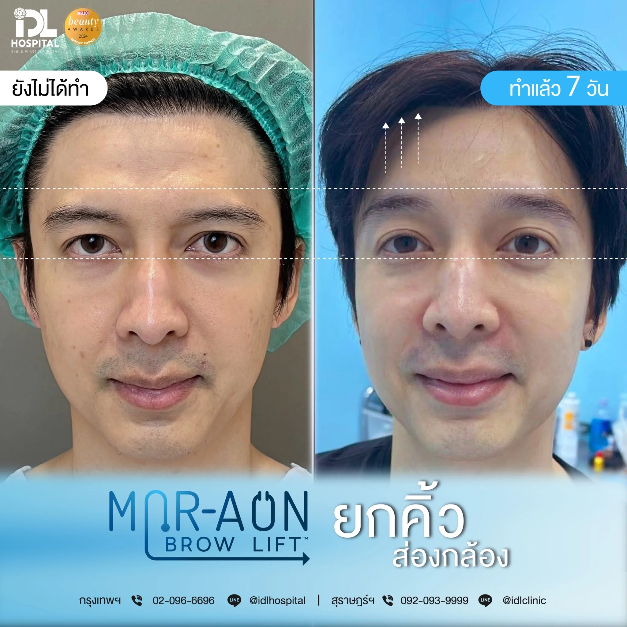 รีวิวลูกค้าที่ทำศัลยกรรมยกคิ้ว