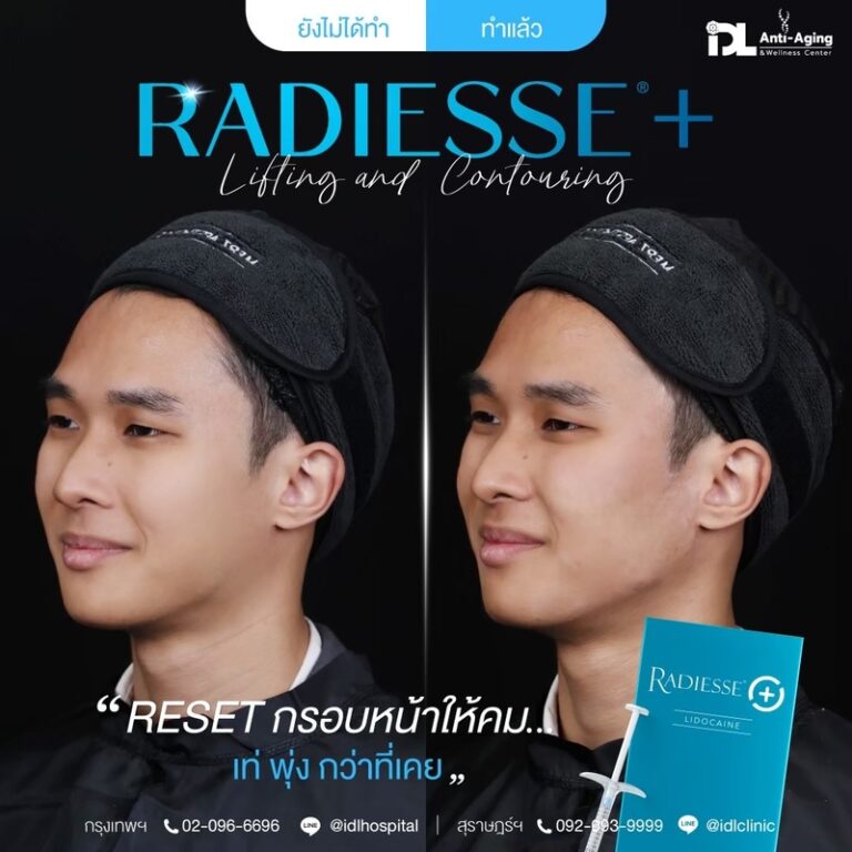 Radiesse+ เรเดียส พลัส