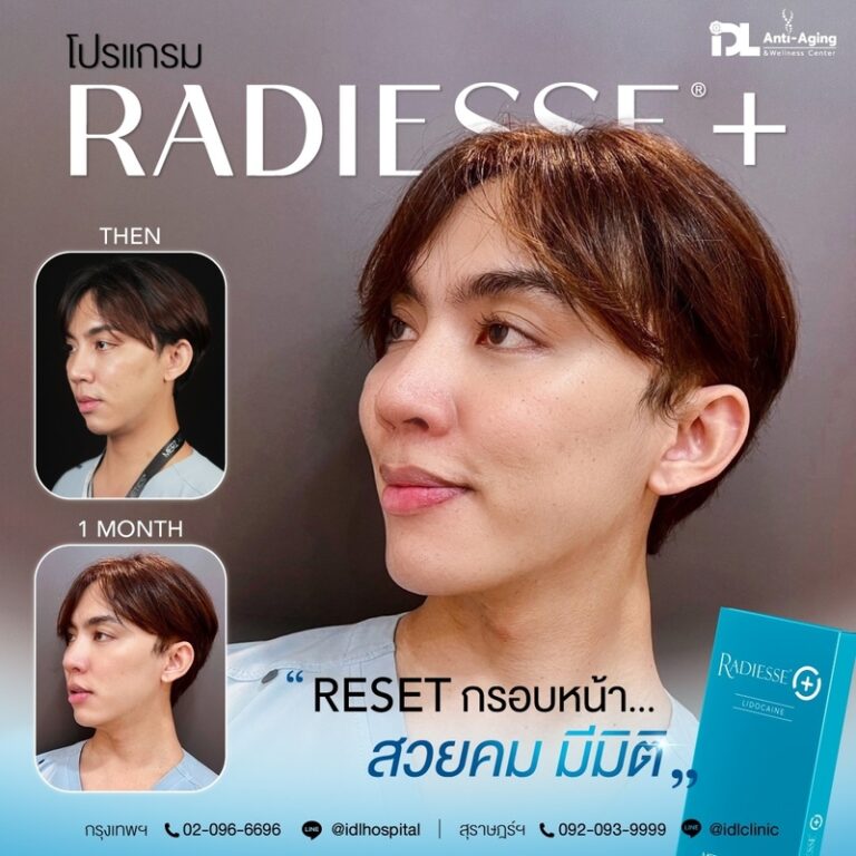 Radiesse+ เรเดียส พลัส