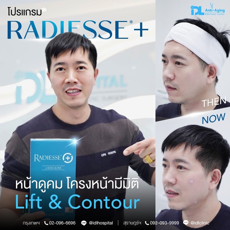 Radiesse+ เรเดียส พลัส