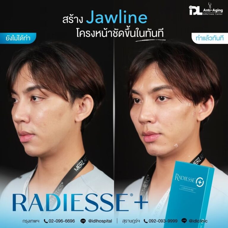 Radiesse+ เรเดียส พลัส