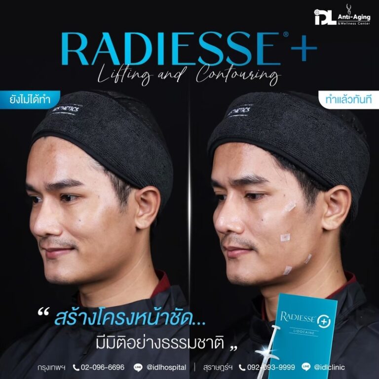 Radiesse+ เรเดียส พลัส