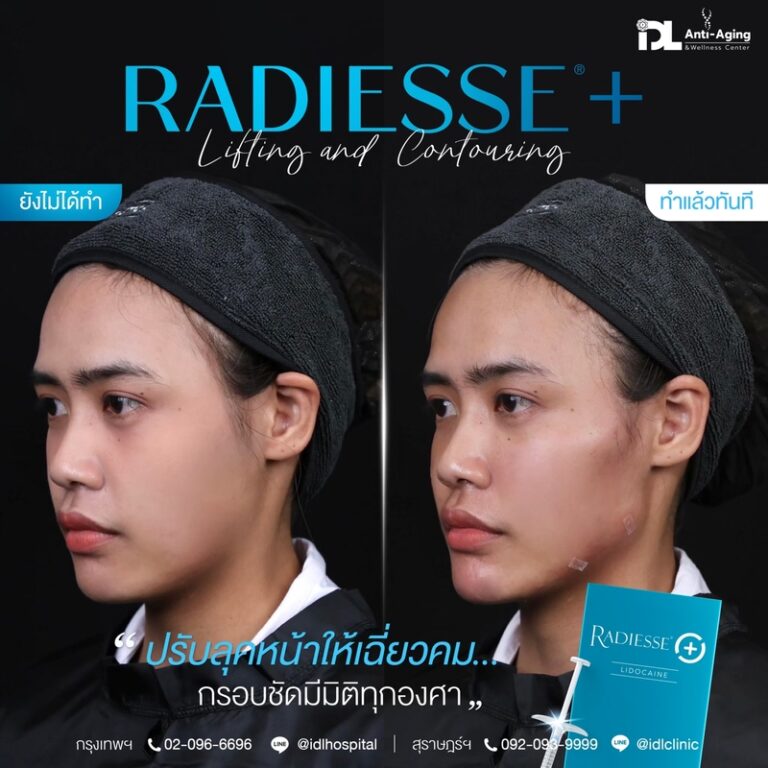 Radiesse+ เรเดียส พลัส