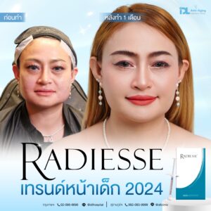รีวิวลูกค้าฉีดเรเดียส (Radiesse) กับ IDL Hospital