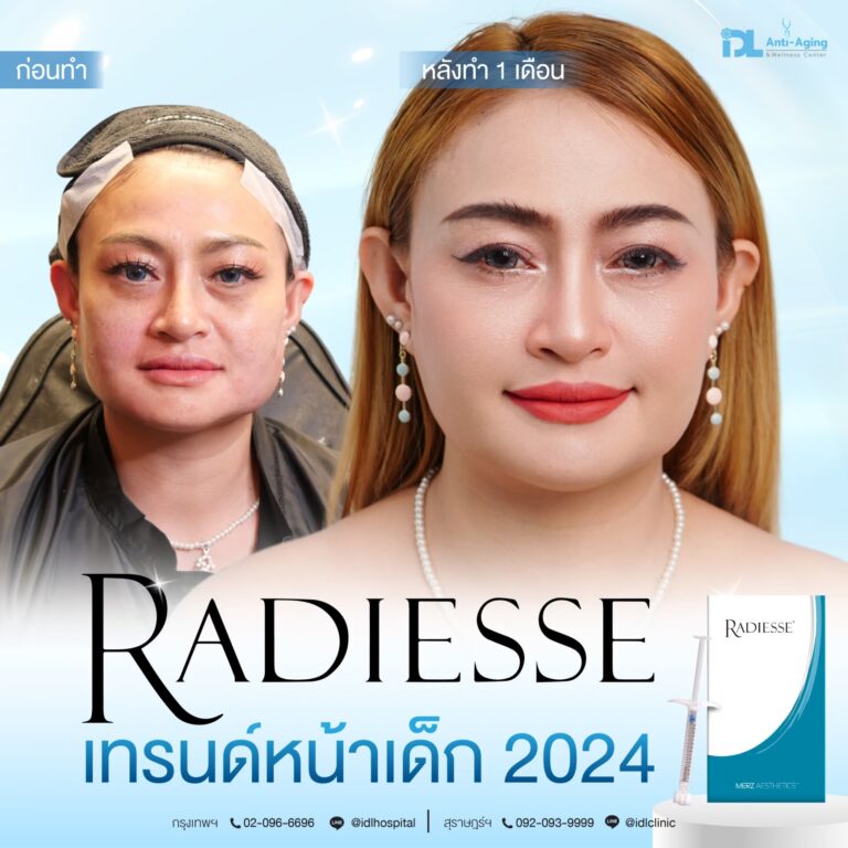 รีวิวลูกค้าฉีดเรเดียส (Radiesse) กับ IDL Hospital