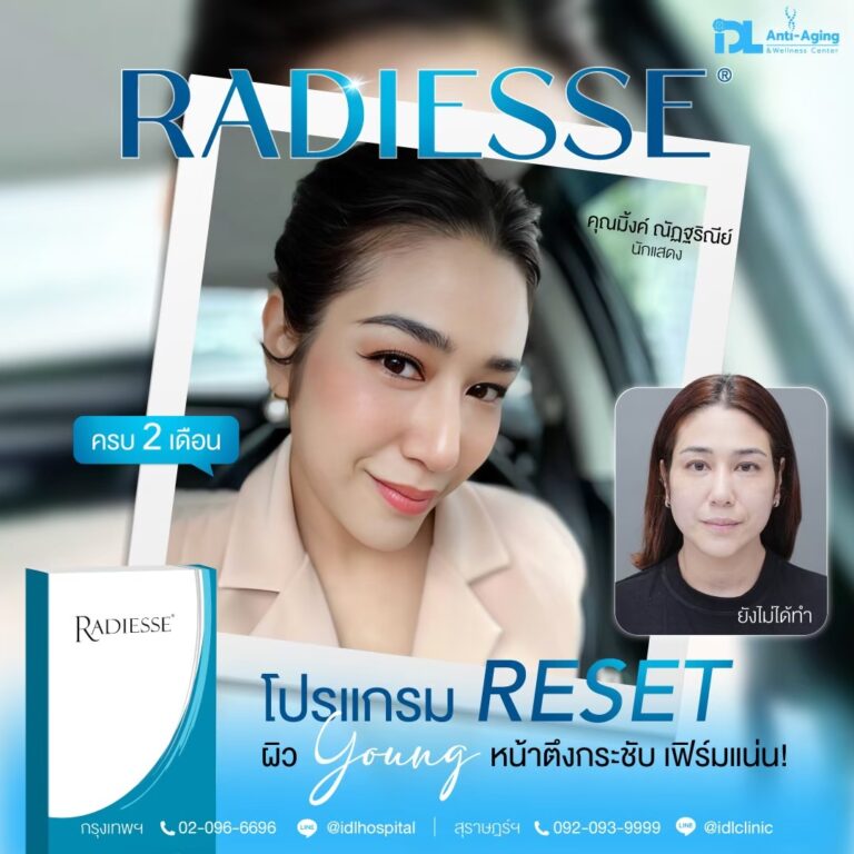 รีวิวลูกค้าฉีดเรเดียส (Radiesse) กับ IDL Hospital