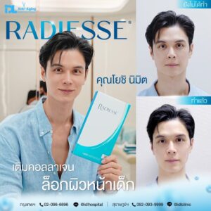 รีวิวลูกค้าฉีดเรเดียส (Radiesse) กับ IDL Hospital