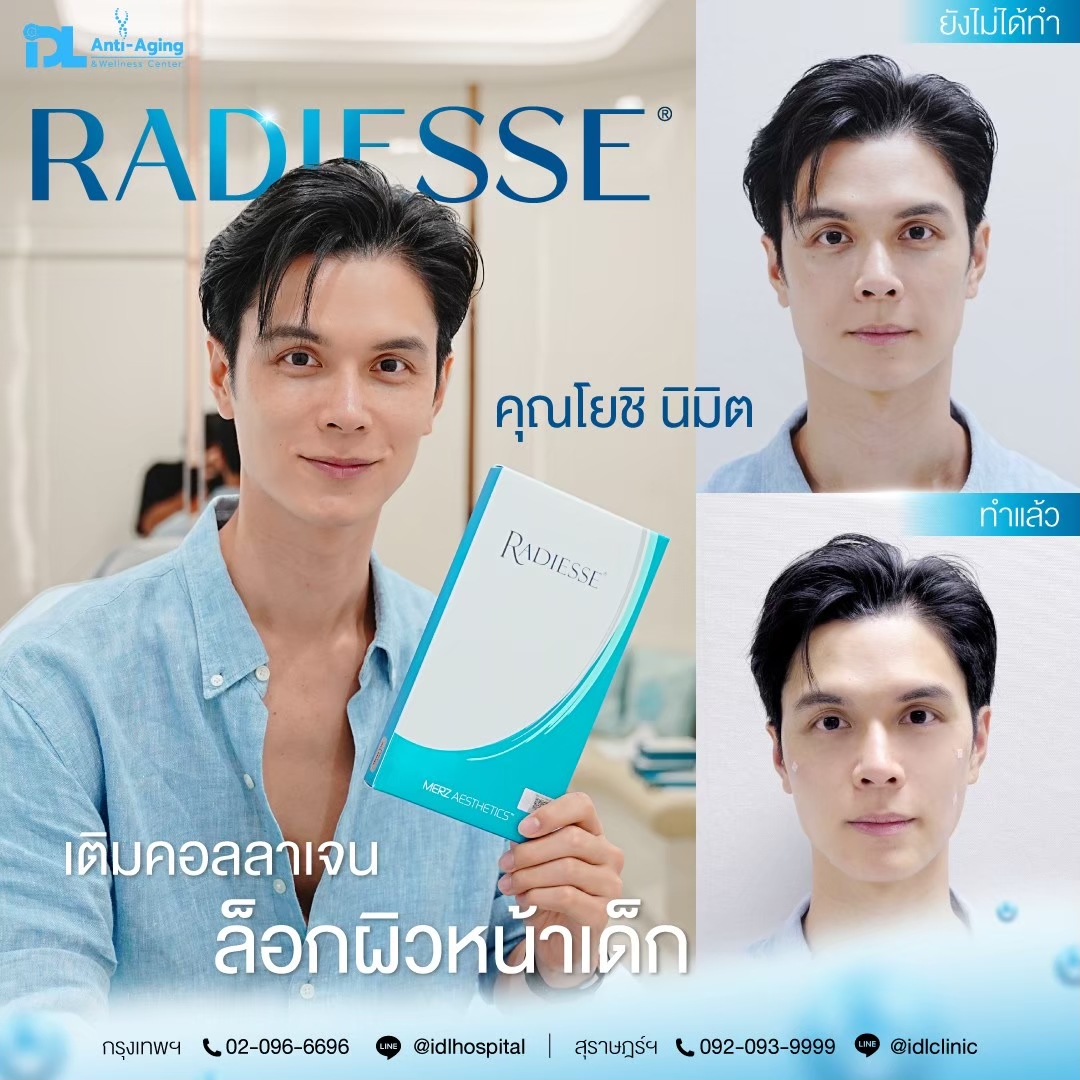 รีวิวลูกค้าฉีดเรเดียส (Radiesse) กับ IDL Hospital