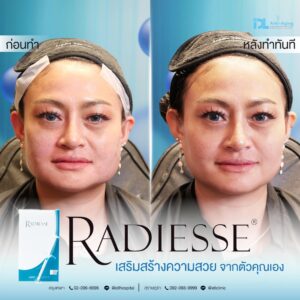 รีวิวลูกค้าฉีดเรเดียส (Radiesse) กับ IDL Hospital