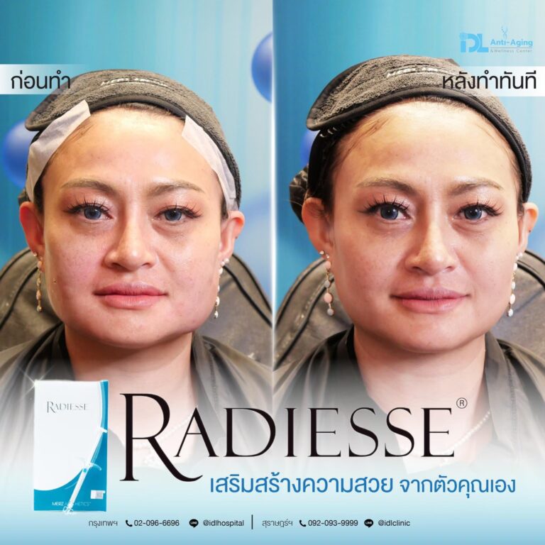 รีวิวลูกค้าฉีดเรเดียส (Radiesse) กับ IDL Hospital