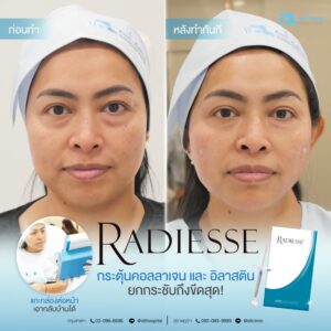 รีวิวลูกค้าฉีดเรเดียส (Radiesse) กับ IDL Hospital