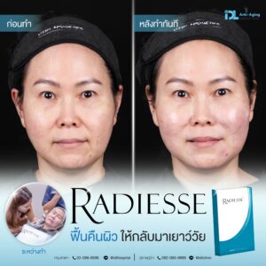 รีวิวลูกค้าฉีดเรเดียส (Radiesse) กับ IDL Hospital