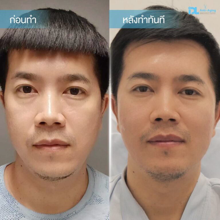 รีวิวลูกค้าฉีดเรเดียส (Radiesse) กับ IDL Hospital