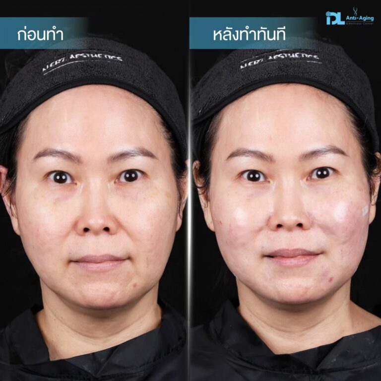 รีวิวลูกค้าฉีดเรเดียส (Radiesse) กับ IDL Hospital