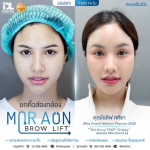 รีวิว ยกคิ้วส่องกล้อง