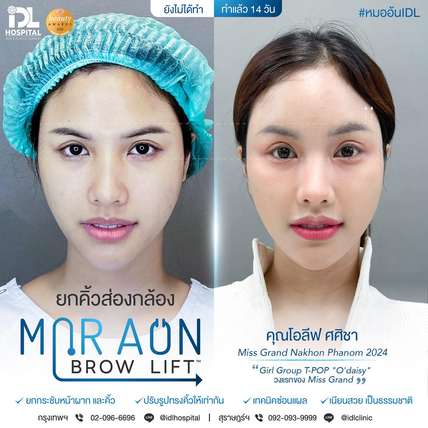 รีวิว ยกคิ้วส่องกล้อง