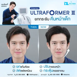 Ultraformer