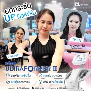 Ultraformer