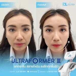 Ultraformer