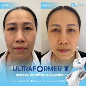 Ultraformer