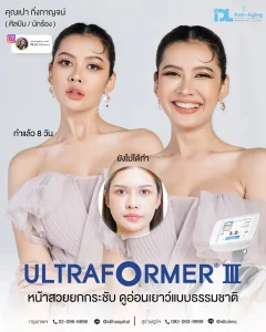 Ultraformer