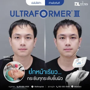 Ultraformer