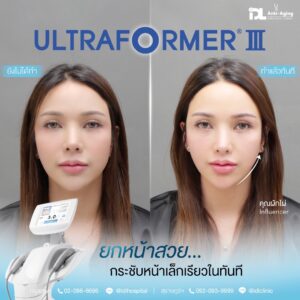 Ultraformer