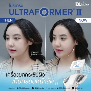 Ultraformer