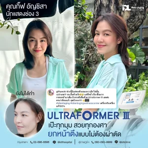 Ultraformer