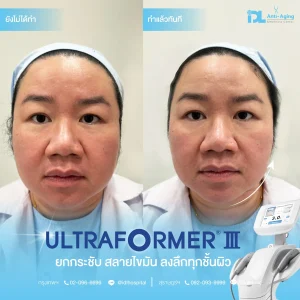 Ultraformer