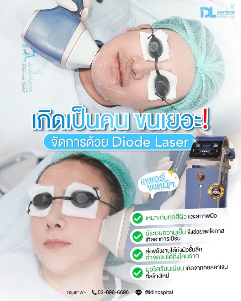 Diode Laser เลเซอร์ขน
